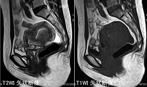 日々の症例 113 子宮腺筋症 Adenomyosis