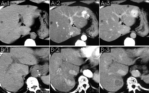 日々の症例 115 肝腫瘍の２症例 肝腫瘍の2症例 A 30歳代 女性 B 70歳代 女性 画像所見 症例a 肝左葉外側区域ｓ3の腫瘤は造影ct動脈相で辺縁から濃厚に染まりはじめ A 2 実質相まで濃染が持続している A 3 症例ｂ 肝右葉後
