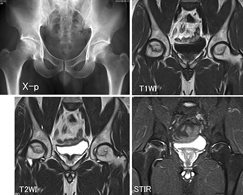 壊死 股関節 股（変形性股関節症、大腿骨頭壊死症、単純性股関節炎、上前腸骨棘剥離骨折、下前腸骨棘剥離骨折）｜岩橋クリニック（吹田市）