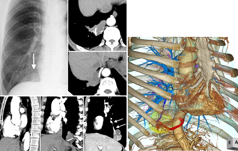 日々の症例 143 肺分画症 Intralobar Pulmonary Sequestration