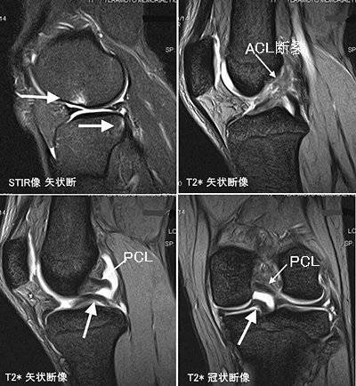 日々の症例 144 Acl断裂 内側半月板バケツ柄断裂