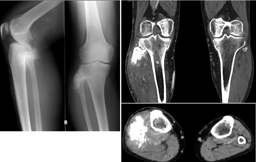 オニオンスキン骨膜反応とは何ですか?