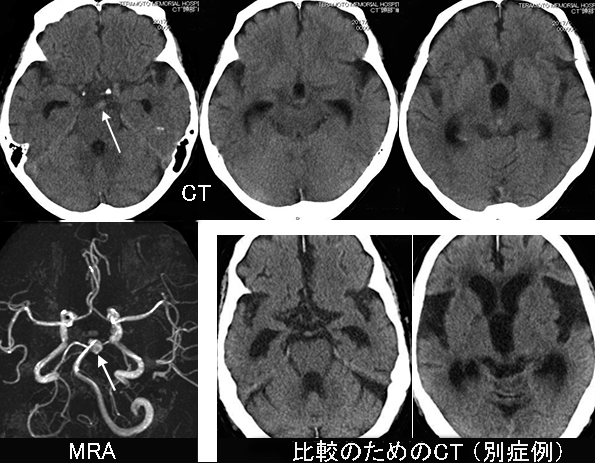 日々の症例 227 くも膜下出血 Sah