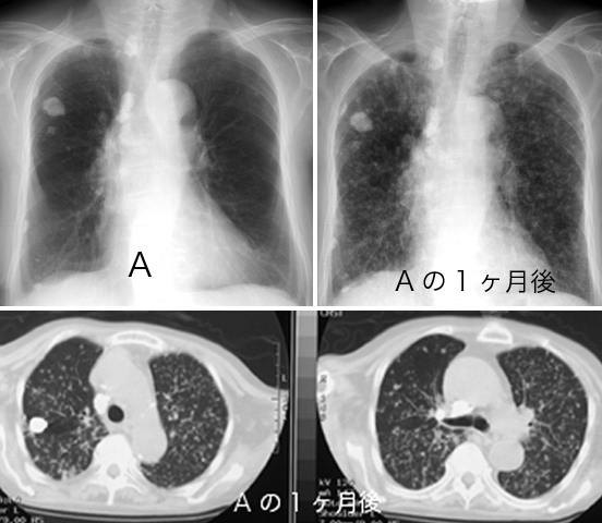 日々の症例 29 粟状結核 29 1 70歳代 女性 約1週間前から38度前後の発熱が持続するため来院した 画像所見 両側全肺野に小粒状影がびまん性に存在し 中下肺野でより密に分布している Ctでは比較的大きさの揃った2mm前後の小結節が既存の