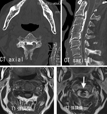 Mri 頚椎