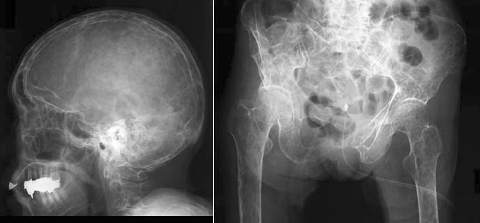 性 末期 多発 骨髄 腫 多発性骨髄腫の進行―高カルシウム血症や腎不全など末期症状について