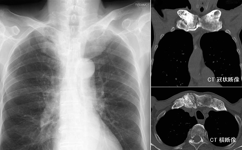 日々の症例 93 Sapho症候群 胸肋鎖骨肥厚症