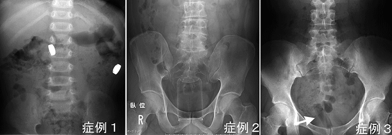 肛門異物挿入 