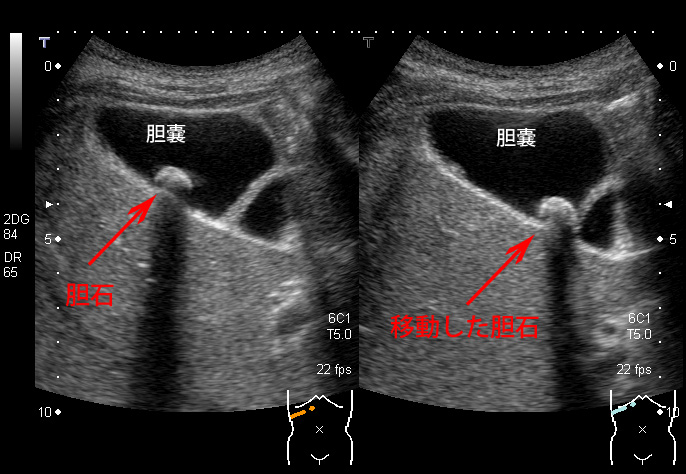 超音波検査の理由
